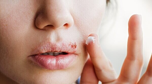 FAQs about cold sore vs. pimples
