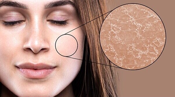 Treat Dehydrated Skin To Reveal The Flawless Skin Beneath