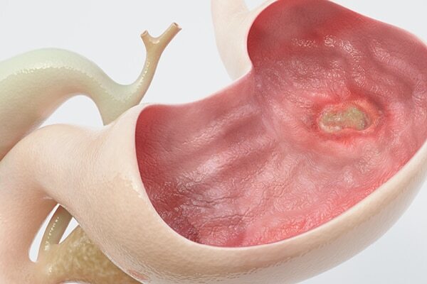 FAQs on triphala benefits