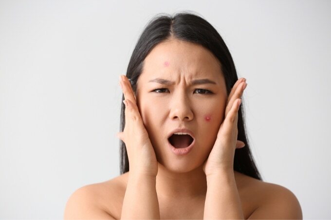 An Expert Guide To Deal With Skin Blemishes: Top 7 Tips
