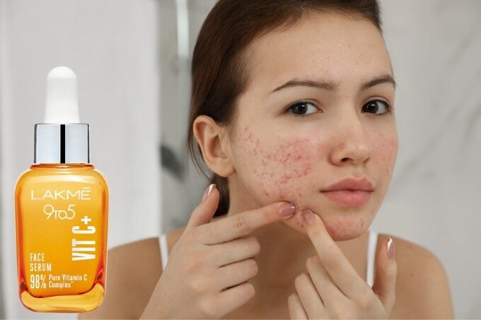 FAQs about How to Deal with Skin Blemishes