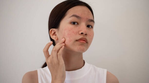 Tips For Easy-To-Follow Solutions Against Pimples