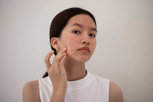 Tips For Easy-To-Follow Solutions Against Pimples