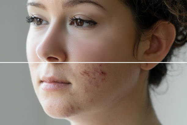 remove-pimples-naturally