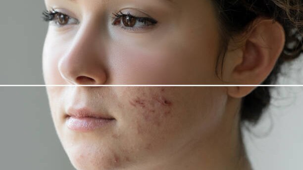 remove-pimples-naturally