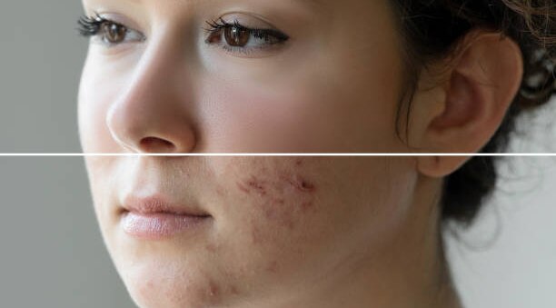 remove-pimples-naturally
