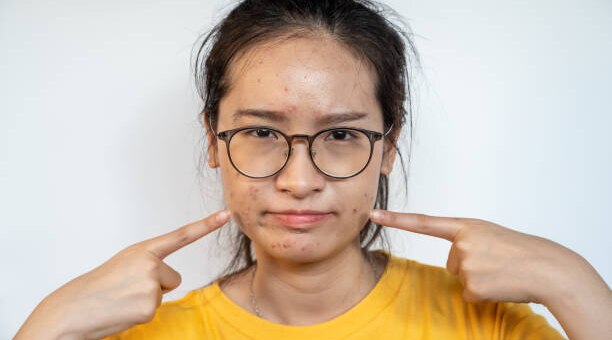 Ultimate Skincare Routine For Oily Skin: Your Guide