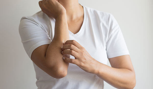 How To Deal With Prickly Heat