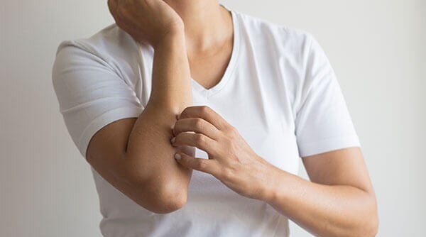 How To Deal With Prickly Heat