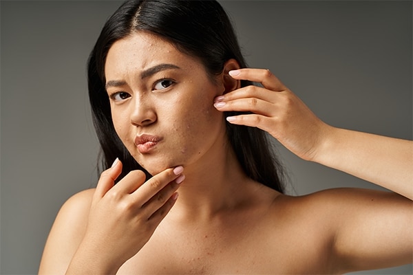 Effective Strategies To Prevent Humidty-Induced Breakouts
