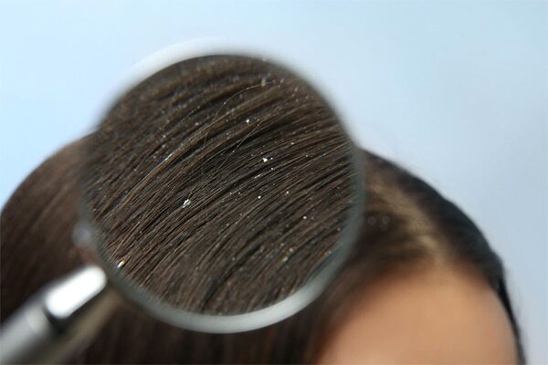 Disease-related dandruff