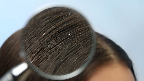 Disease-related dandruff