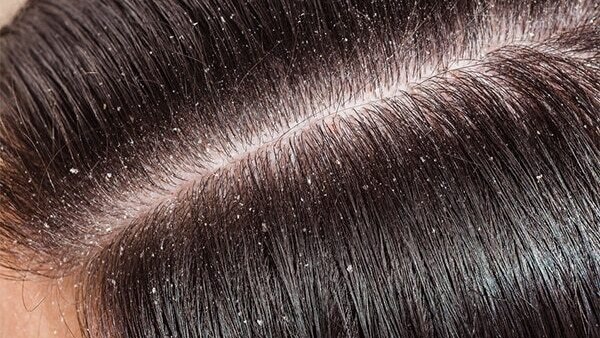 Disease-related dandruff