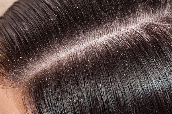 Disease-related dandruff