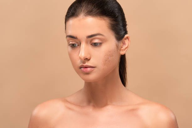 Get Rid Of Acne Scars Here’s How
