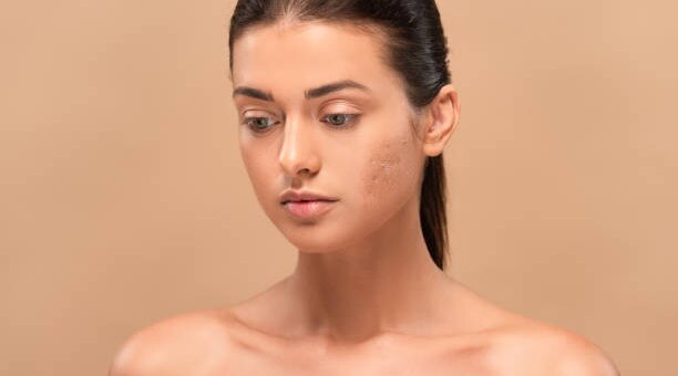 Get Rid Of Acne Scars Here’s How