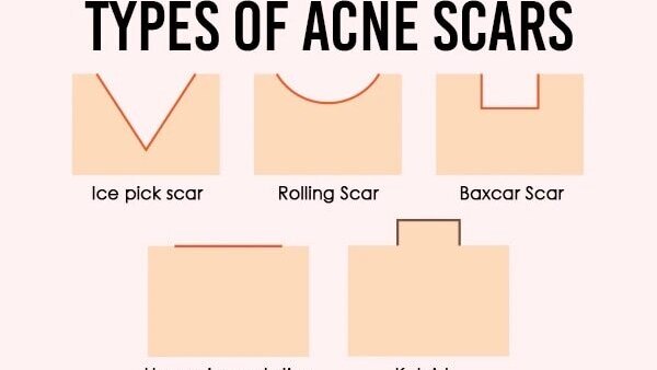how to remove acne scars Simple Kind To Skin Soothing Facial Toner