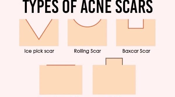 how to remove acne scars Simple Kind To Skin Soothing Facial Toner