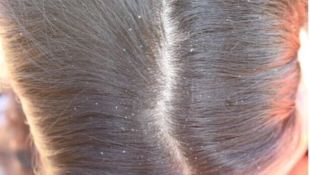FAQs about benefits of curd for hair