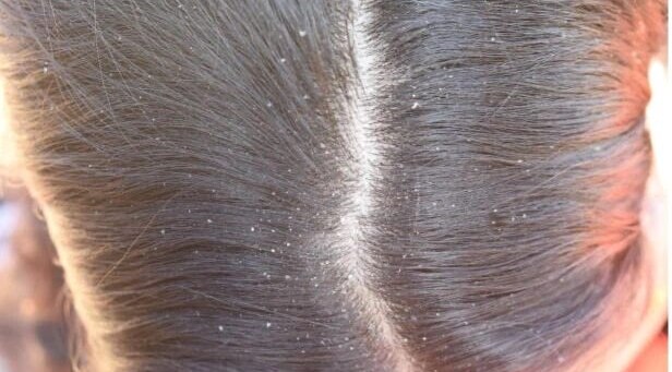 FAQs about benefits of curd for hair