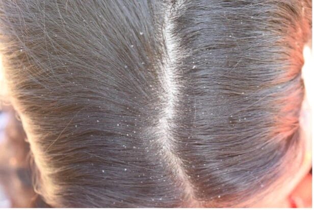FAQs about benefits of curd for hair