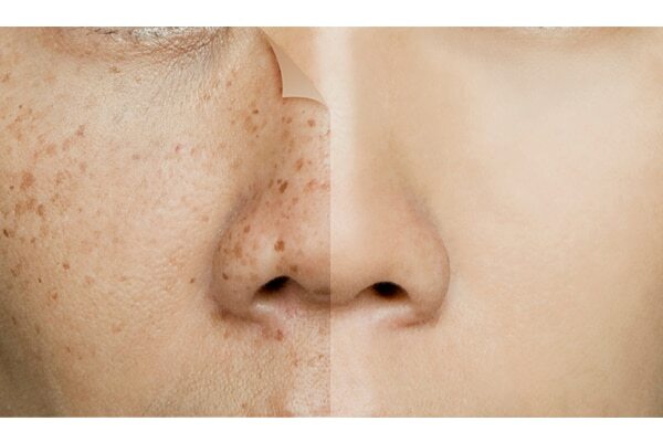 FAQs about guava benefits for skin