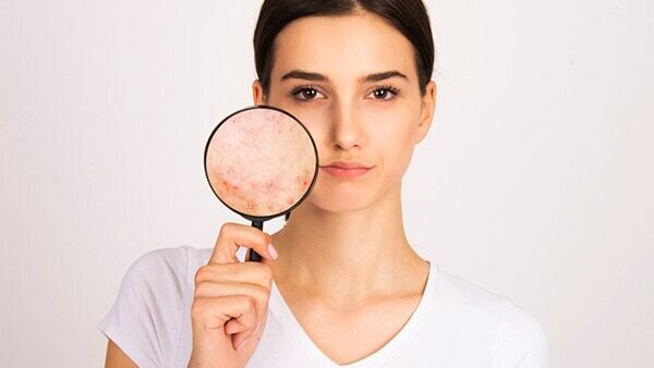 #5: Pick water-based sunscreens if you have oily, acne-prone skin