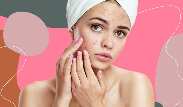 Benzoyl Peroxide V/S Salicylic Acid: What Works Best To Treat Acne