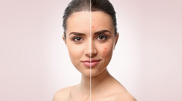 Reduces inflammation