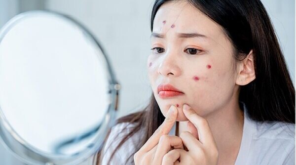 An Expert’s Guide On Safely Treating Pimples During Pregnancy