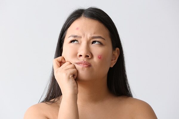 FAQs about pregnancy acne