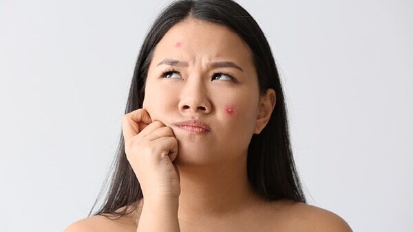 FAQs about pregnancy acne