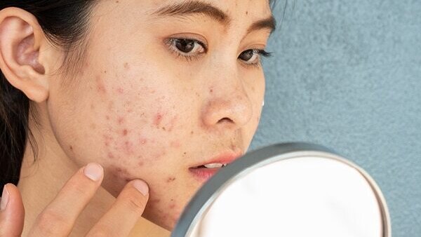 FAQs about pregnancy acne