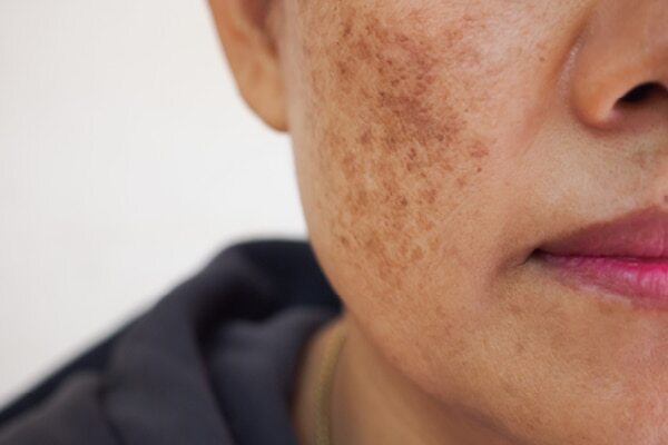 Fights pigmentation