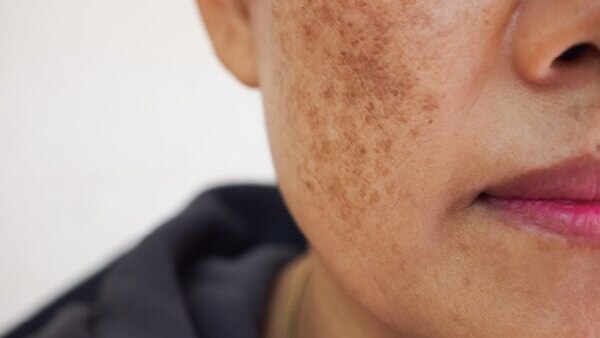 Fights pigmentation