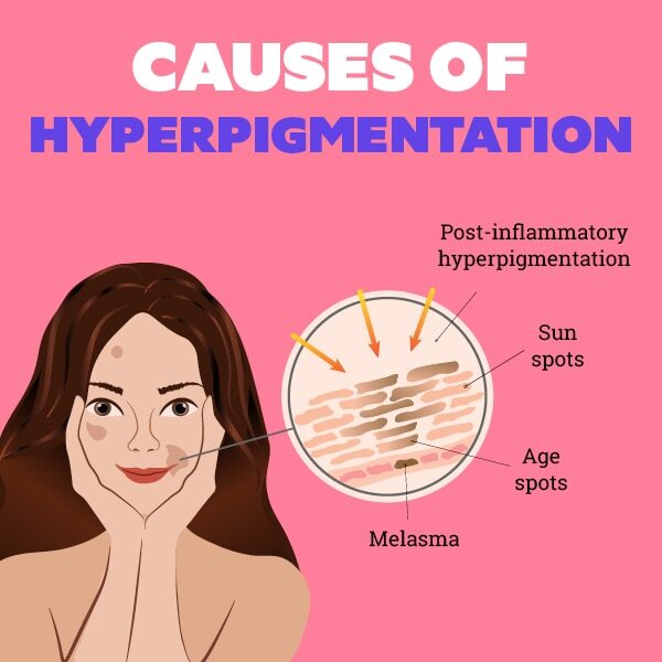 FAQs about hyperpigmentation treatment