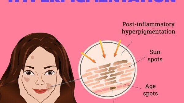 FAQs about hyperpigmentation treatment