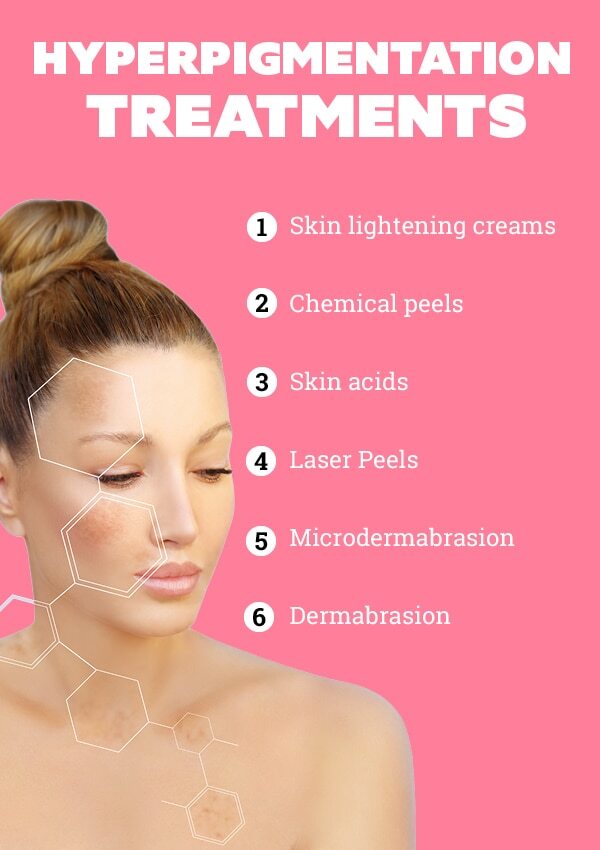 FAQs about hyperpigmentation treatment