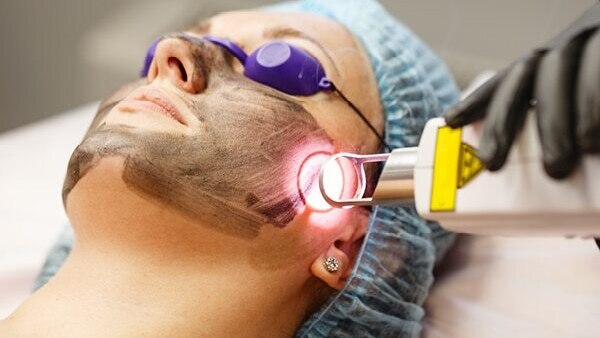 FAQs about hyperpigmentation treatment