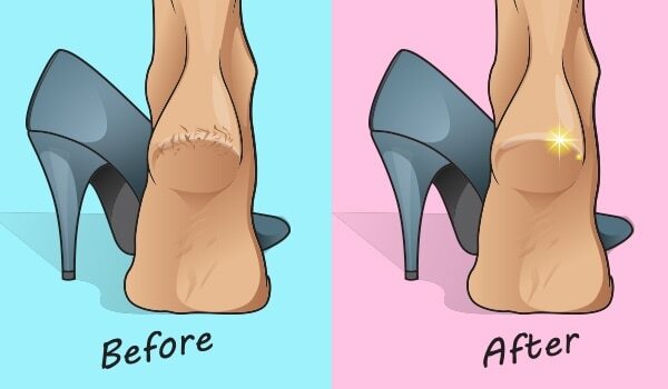 Say Goodbye To Cracked Heels With These Easy Home Remedie