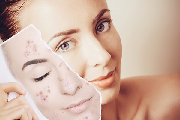 Sandalwood For Swelling