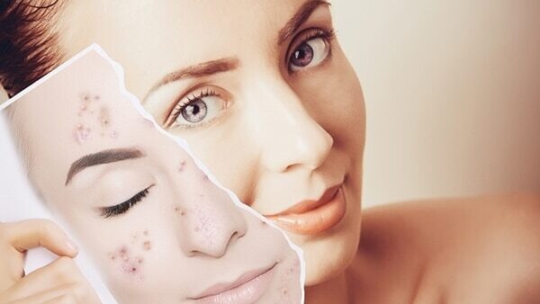 Sandalwood For Swelling