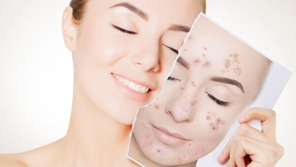 Sandalwood For Swelling