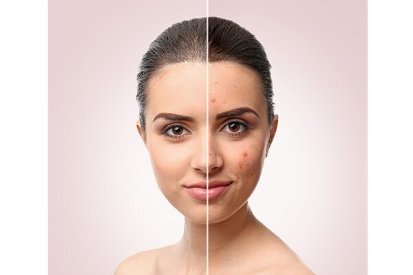 Canola seeds benefits 12: Controls frizz
