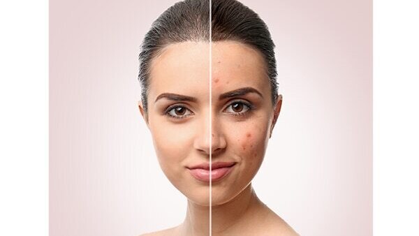 Canola seeds benefits 12: Controls frizz