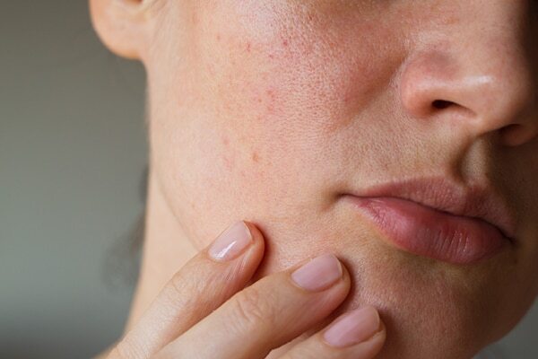 Canola seeds benefits 12: Controls frizz