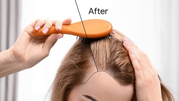 Walnut oil benefits 12: Helps reduce migraine attacks