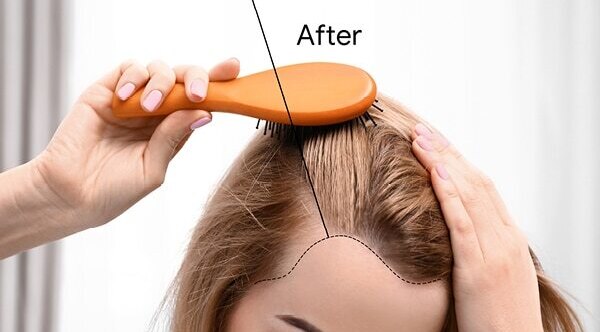 Walnut oil benefits 12: Helps reduce migraine attacks
