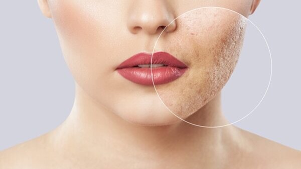 FAQs about facial scars