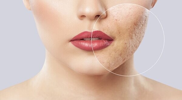 FAQs about facial scars